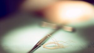 Fil résorbable : que faire quand il ne se résorbe pas ?